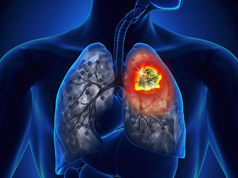 Những điều bạn nên biết về phương pháp phòng bệnh ung thư phổi